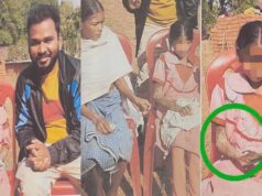 पत्थर जैसी बन रही बच्ची का होगा इलाज, बाल आयोग ने मामले में दिखाई सक्रियता